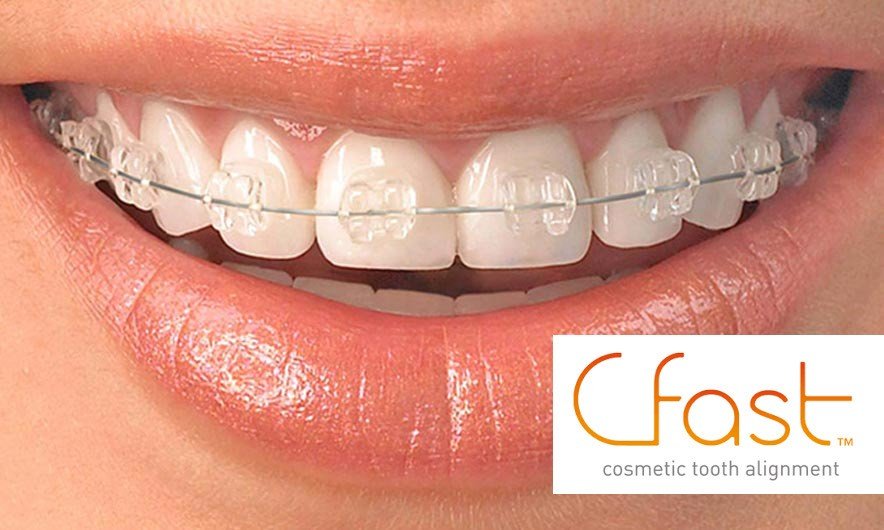 Cfast Braces Oadby Teeth Straightening Orthodontics Wigston