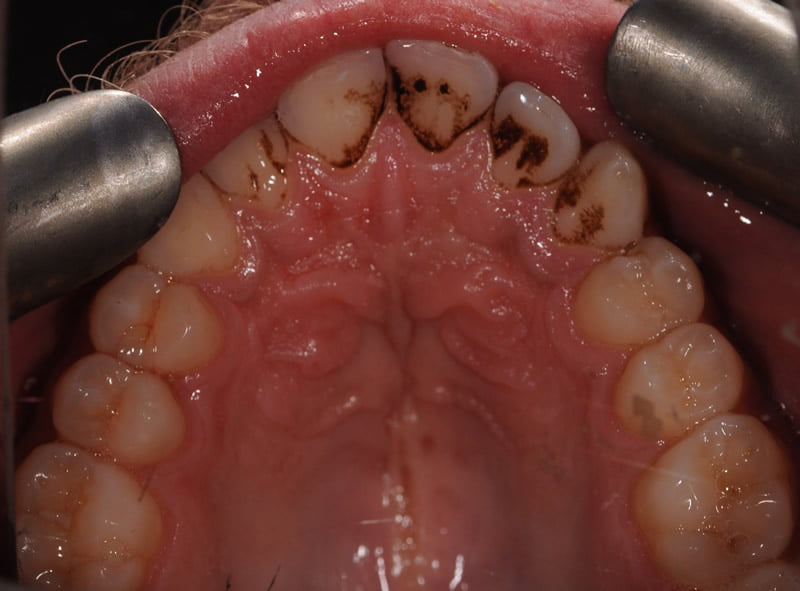 Airflow Polishing Wigston Dental and Cosmetic Clinic