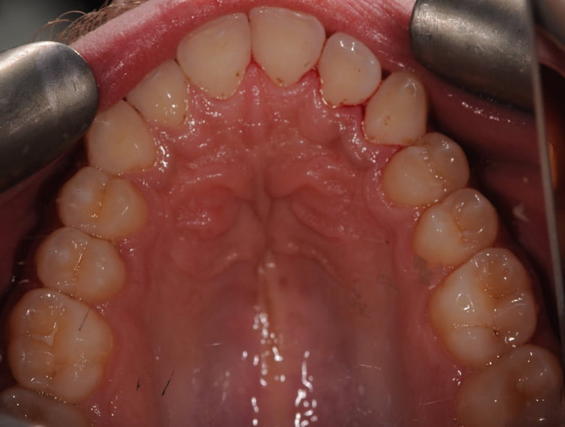 Airflow Polishing Wigston Dental and Cosmetic Clinic