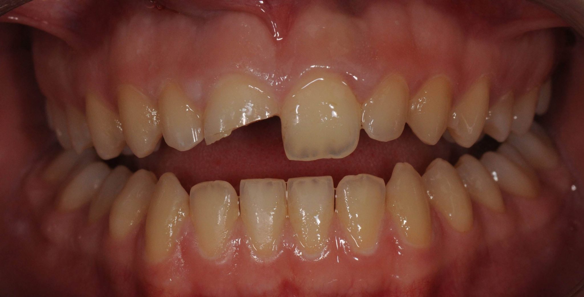 Smile of the week! E.max Crown The Dental and Cosmetic Clinic