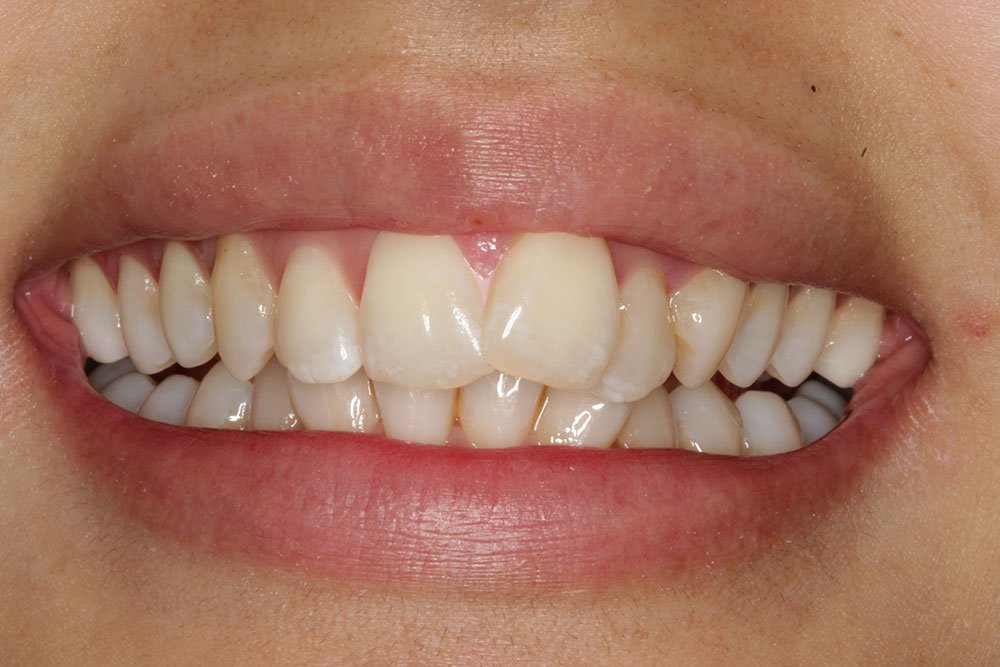 Invisalign Leicester Composite Bonding Wigston