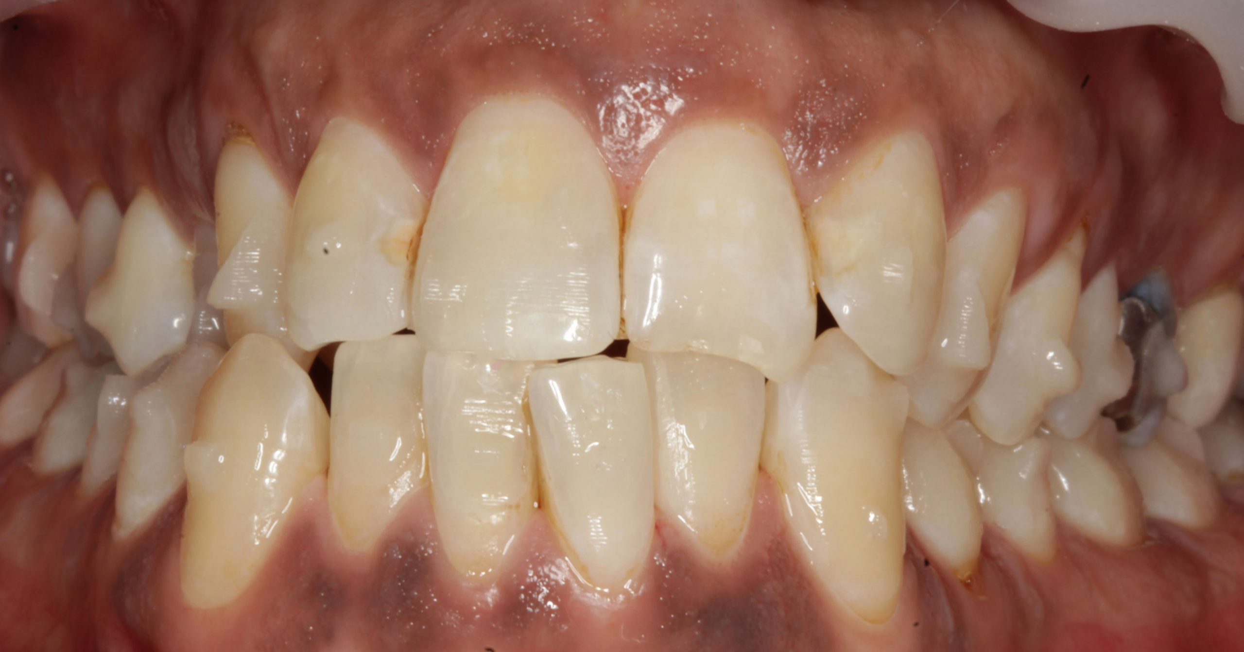 Dentist Leicester Smile Makeover Cosmetic Dentist Wigston