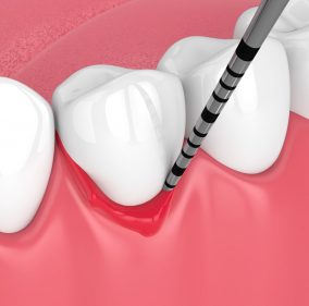 peri implantitis