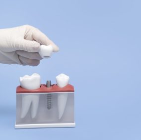 Hand holds a model of tooth implantation.